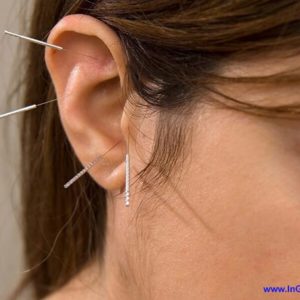 Насколько эффективно иглоукалывание для похудения?